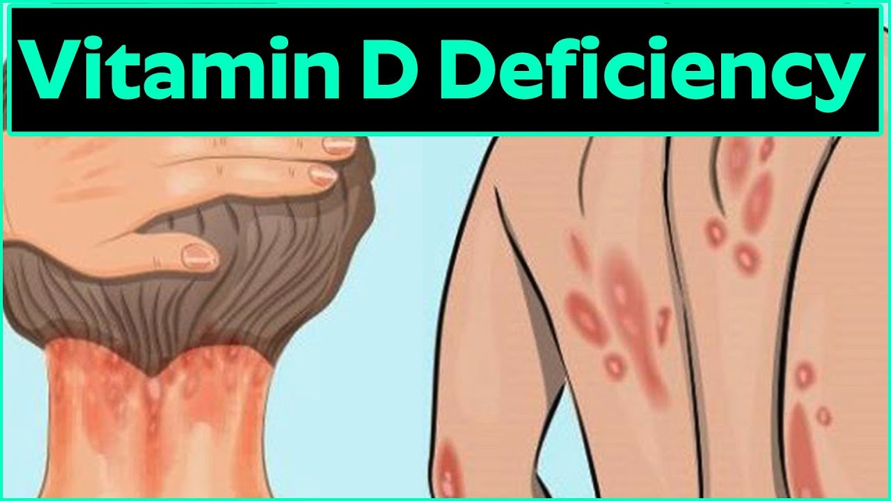 what-is-vitamin-d-deficiency-disease-common-nutrient-deficiencies