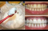 How To Whiten Your Yellow Teeth Naturally At Home – दांत चमकाना – Tooth Whitening