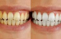 Teeth Whitening By Simple Beauty Secrets