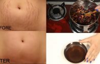 How To Remove Pregnancy Stretch Marks Works 100% – Cure Injury & Burn In 3 Days Miracle Oil
