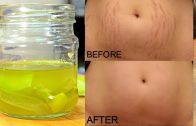 How To Remove Stretch Marks Permanently Works 100% – Cure Injury & Burn In 3 Days Miracle Oil