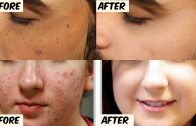 Remove spots on your face – पुराने से पुराने पिंपल व झाइयां के दाग और घाव के निशान हटाने के रामबाण नुस्खे