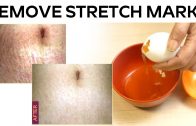 Simple Ways To Clear Stretch Marks At Home