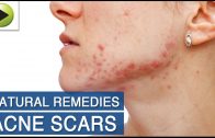 Skin Care – Acne Scars – Natural Ayurvedic Home Remedies