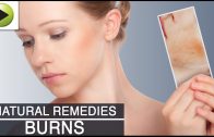 Skin Care – Burns – Natural Ayurvedic Home Remedies