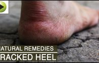 Skin Care – Cracked Heel – Natural Ayurvedic Home Remedies