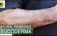 Skin Care – Leucoderma – Natural Ayurvedic Home Remedies