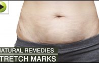 Skin Care – Stretch Marks – Natural Ayurvedic Home Remedies