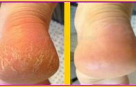 Home Remedy To Get Rid of Cracked Heels In 3 Days (Works 100%)