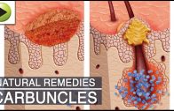 Home Remedies for Carbuncles