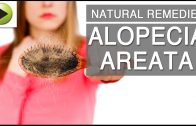 Natural Home Remedies for Alopecia Areata