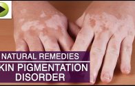Skin Care – Skin Pigmentation – Natural Ayurvedic Home Remedies