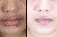 (30 Days Challenge) Remove Dark spots, Black spots & Acne Scars – Simple Beauty Secrets