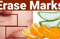 Erase Stretch Marks With In Days | Get Rid of Stretch Marks Fast