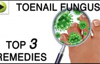 Toenail Fungus – Natural Ayurvedic Home Remedies