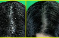 Just 1 Wash To Get Rid of Dandruff Permanently – Home Remedy To Remove Dandruff