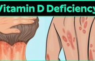 What Is Vitamin D Deficiency Disease – Common Nutrient Deficiencies