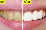 How To Whiten Your Teeth Naturally At Home – Remove Plaque &amp – Stains – Teeth Whitening At Home