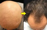 Causes of Hair Loss and Baldness – cures for hair loss – Types of Baldness -Dermatologist