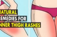 Natural Remedies for Inner Thigh Rashes – Health Sutra – Best Health Tips