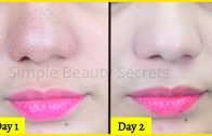 Just 1 Use &amp – Say Goodbye To Unwanted Blackheads &amp – Whiteheads Permanently, Blackheads Removal Remedy