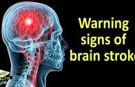 Warning Signs of Brain Stroke – Health Tips